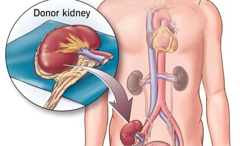 Miracles of kidney transplantation: advantages, methods, and all the information needed for individuals with end-stage renal failure