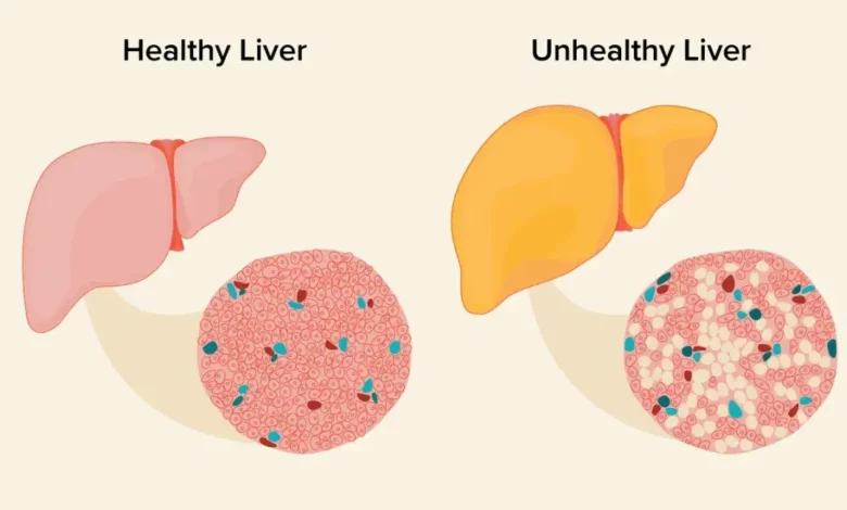 Understanding Fatty Liver: Types, Symptoms, and Recommended Foods