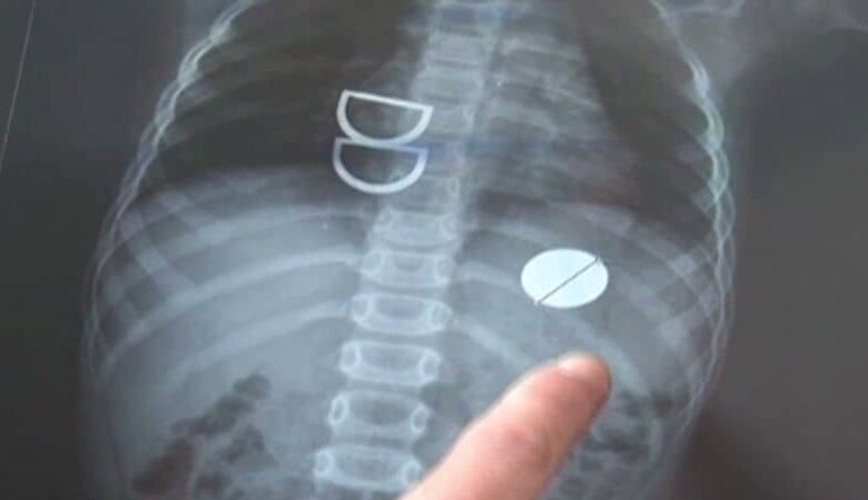 Doctor at Moolchand Hospital Safely Removes Swallowed Coin, Saves Young Boy's Life