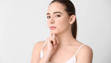 Acne Insights: Breakouts May Reveal Underlying Health Issues